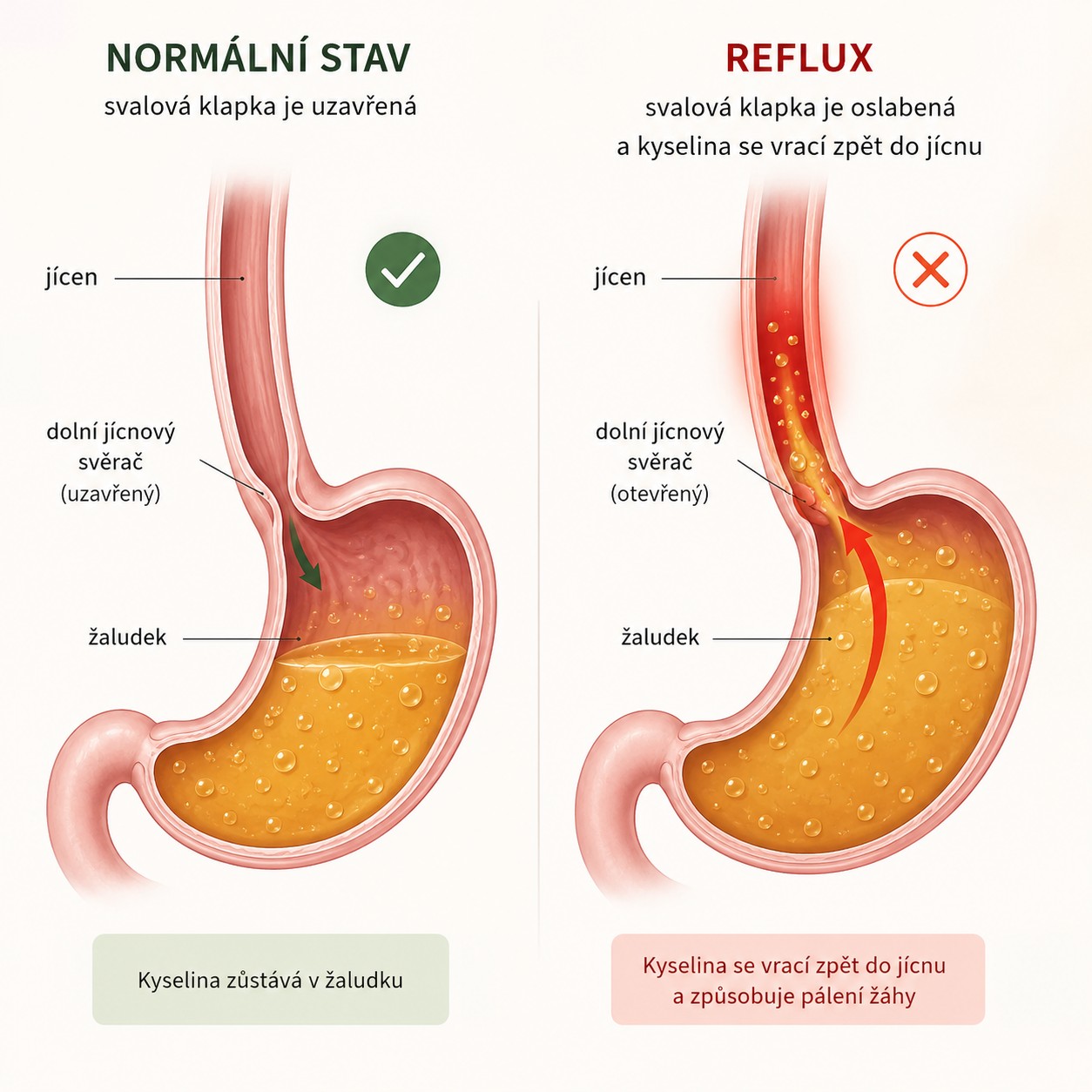 Ilustrace refluxu a pálení žáhy, kdy se žaludeční kyselina vrací zpět do jícnu